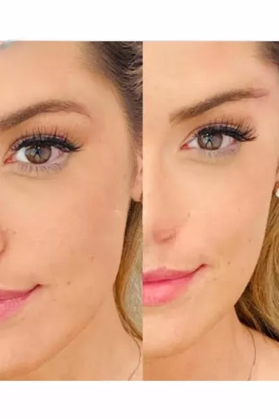 لون القهوة شد الوجه البوتوكس مشبك شد الوجه رفع الحاجب رفع العين شد الوجه