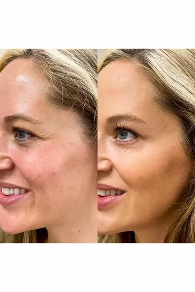 Ботокс с пряжкой глаз брови подтяжка шеи подтяжка лица (черный) - ультра сильный эффект